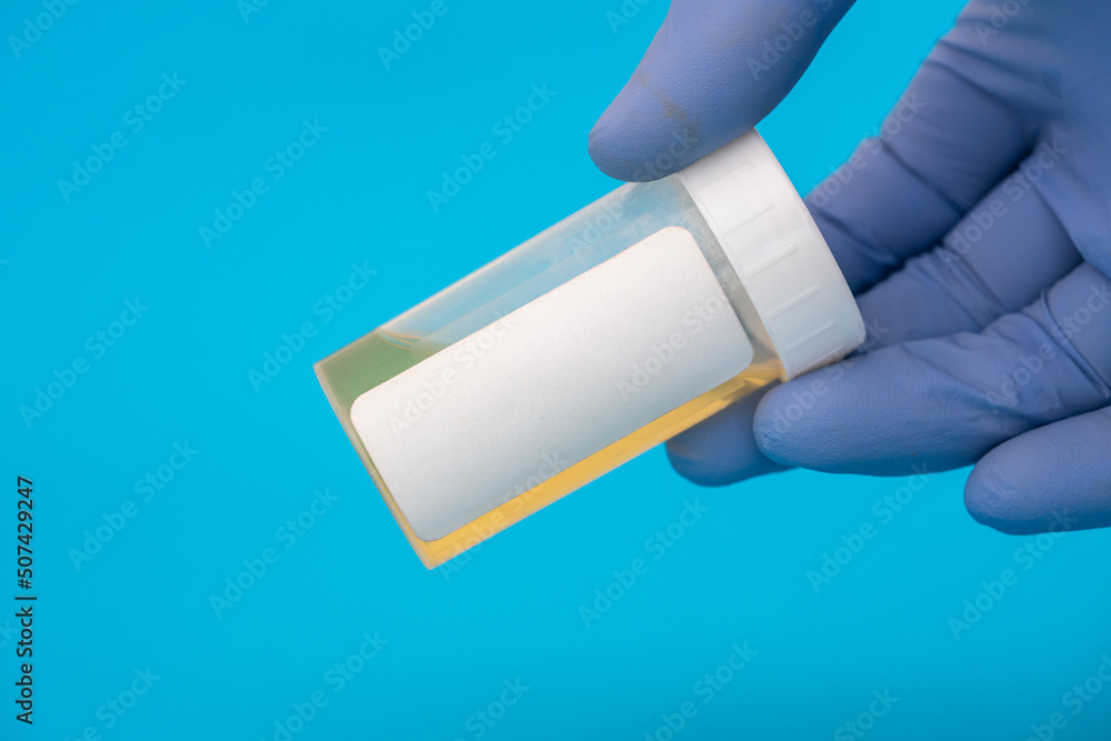 Urine analysis/Microscopy